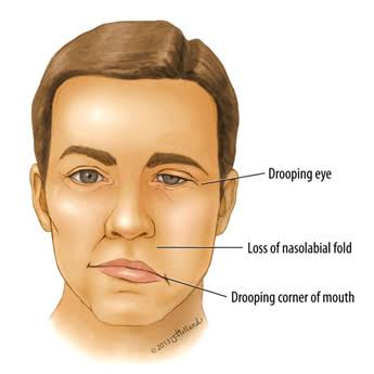 Bell's Palsy