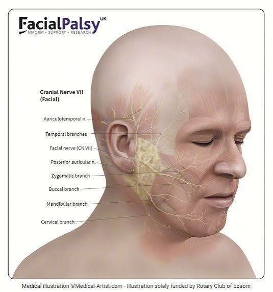 Facial Nerve Palsy