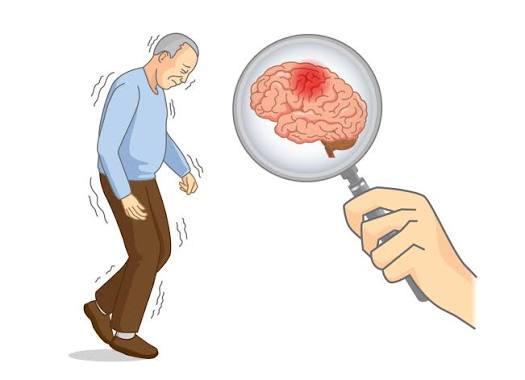 Parkinson's Disease