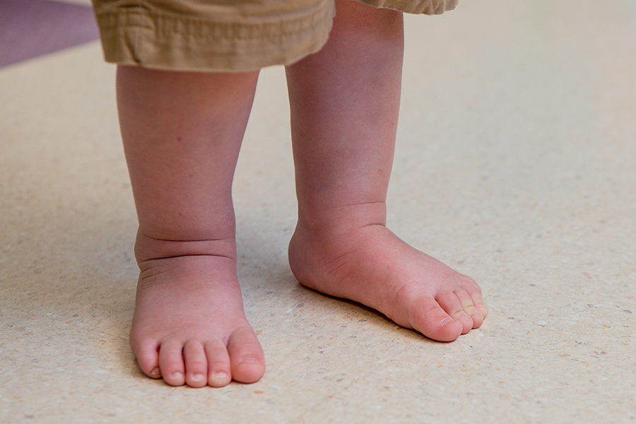 Flat Foot Correction