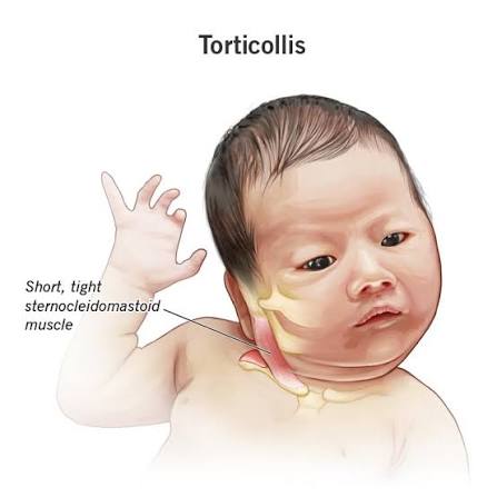 Torticollis Treatment