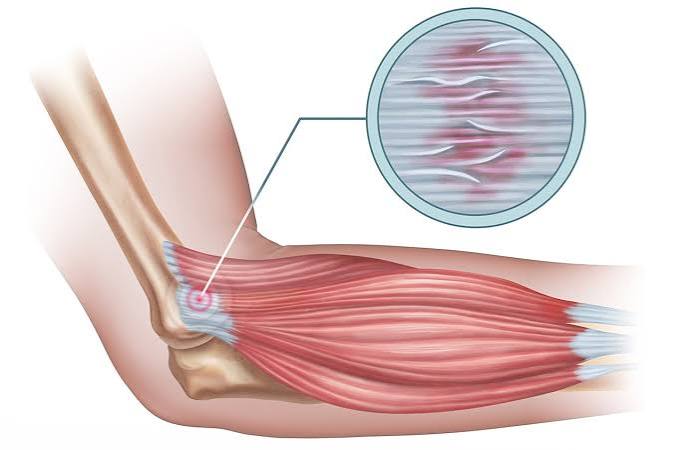 Tennis Elbow