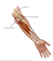 Golfer's Elbow