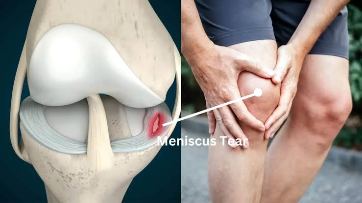Meniscus Injury