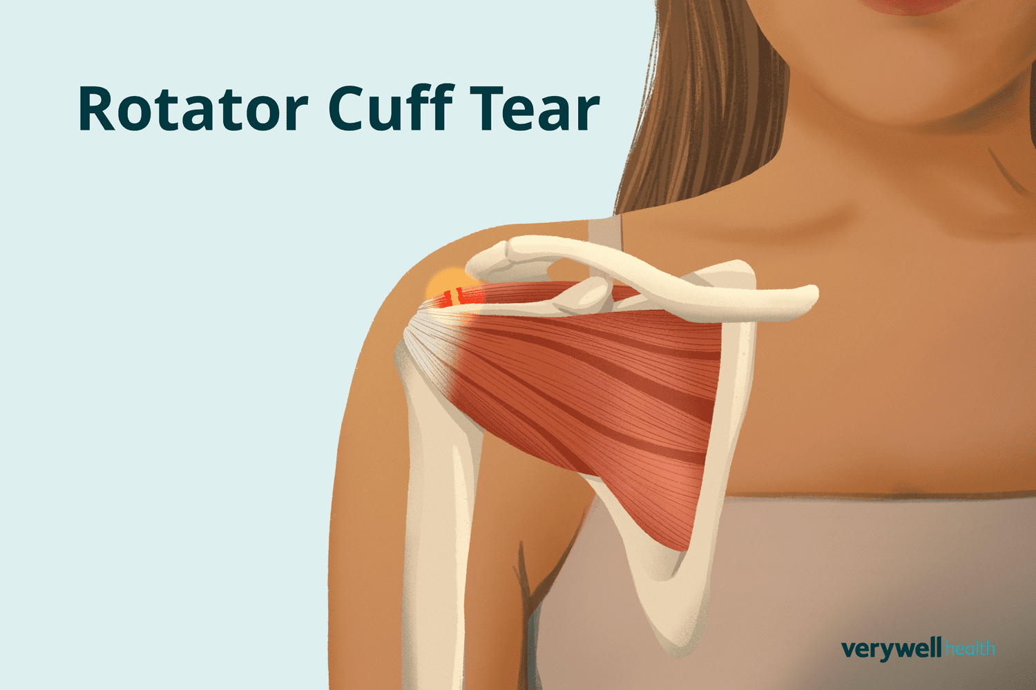 Rotator Cuff Injury